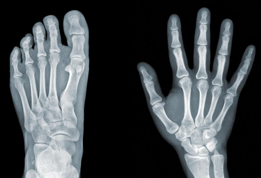 Image of an x-ray of a left foot and a right hand. Imaging and x-ray are some of the many services provided at North Idaho Orthopedics and sports medicine NIOSM